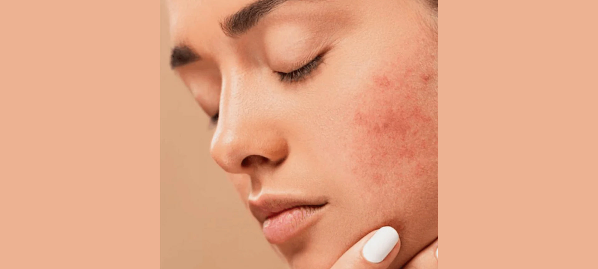 Rosacea - Everything That You Need To Know About This Skin Condition - Secret Skin