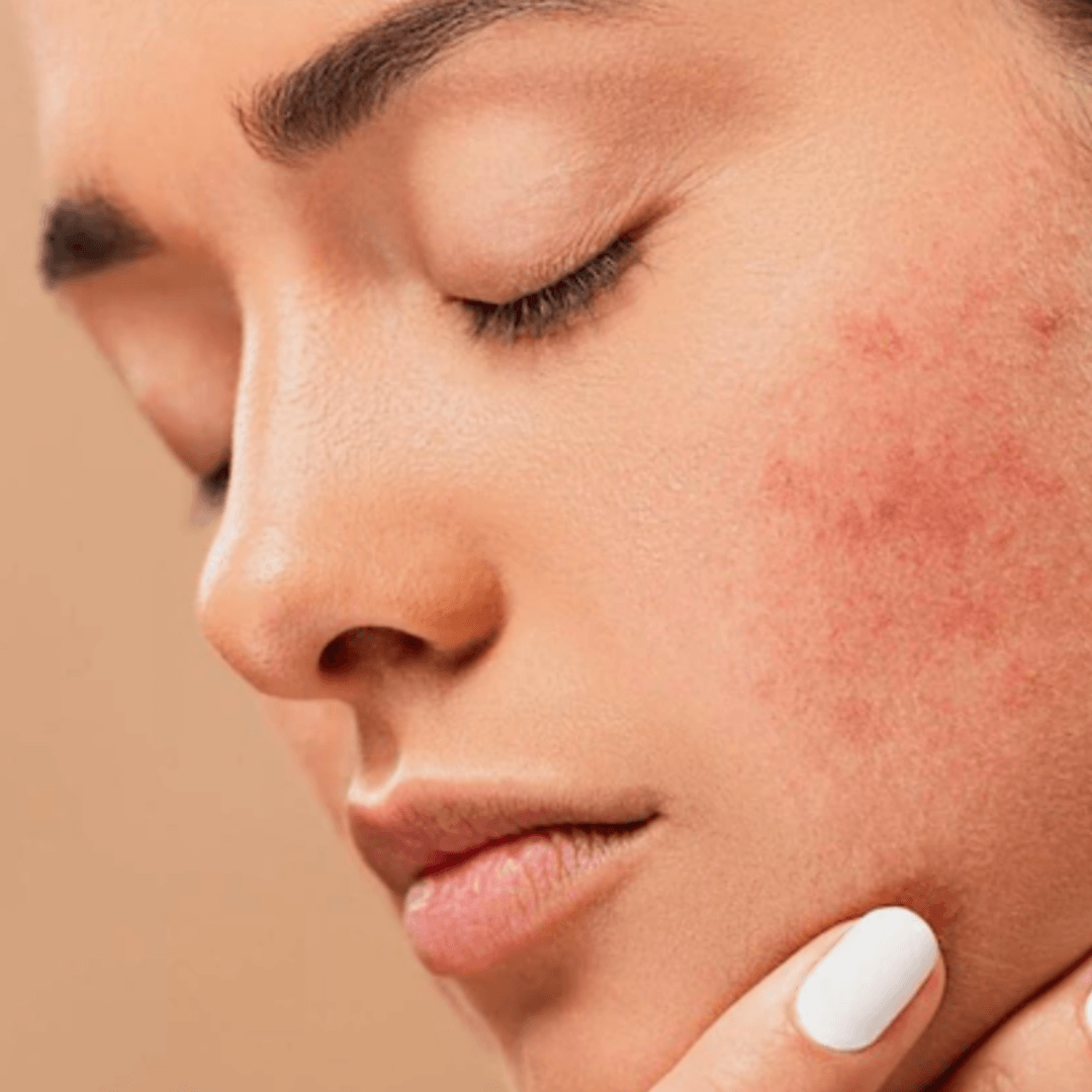 Rosacea - Everything That You Need To Know About This Skin Condition - Secret Skin